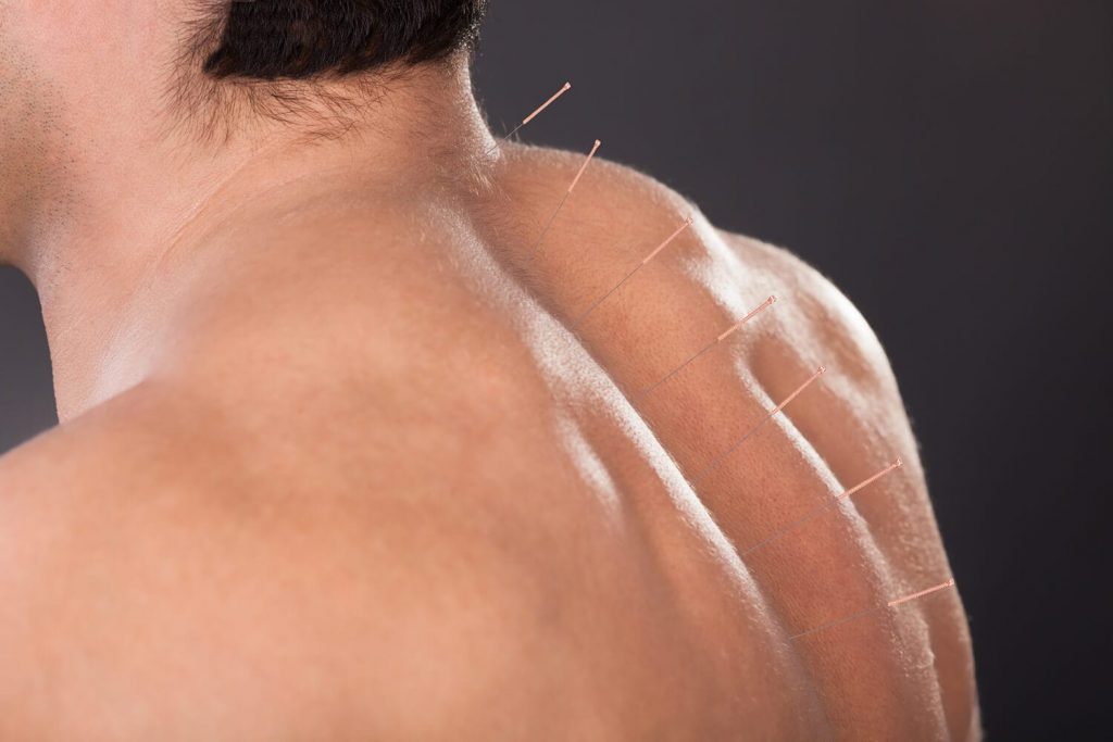 Acupuncture for back pain in Albuquerque