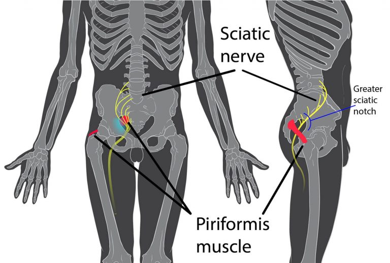 Sciatica Pain Management With Acupuncture And More - Endpoint Wellness